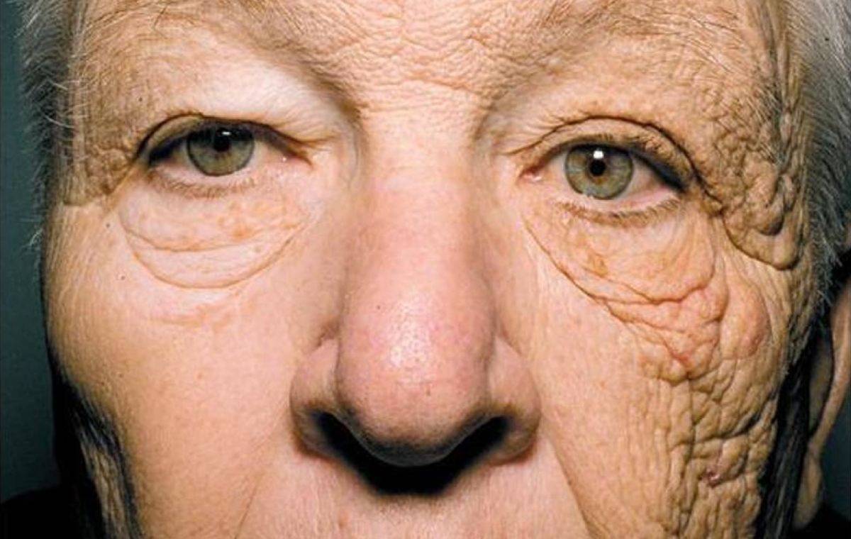 قرمزی گردن در اثر نور خورشید