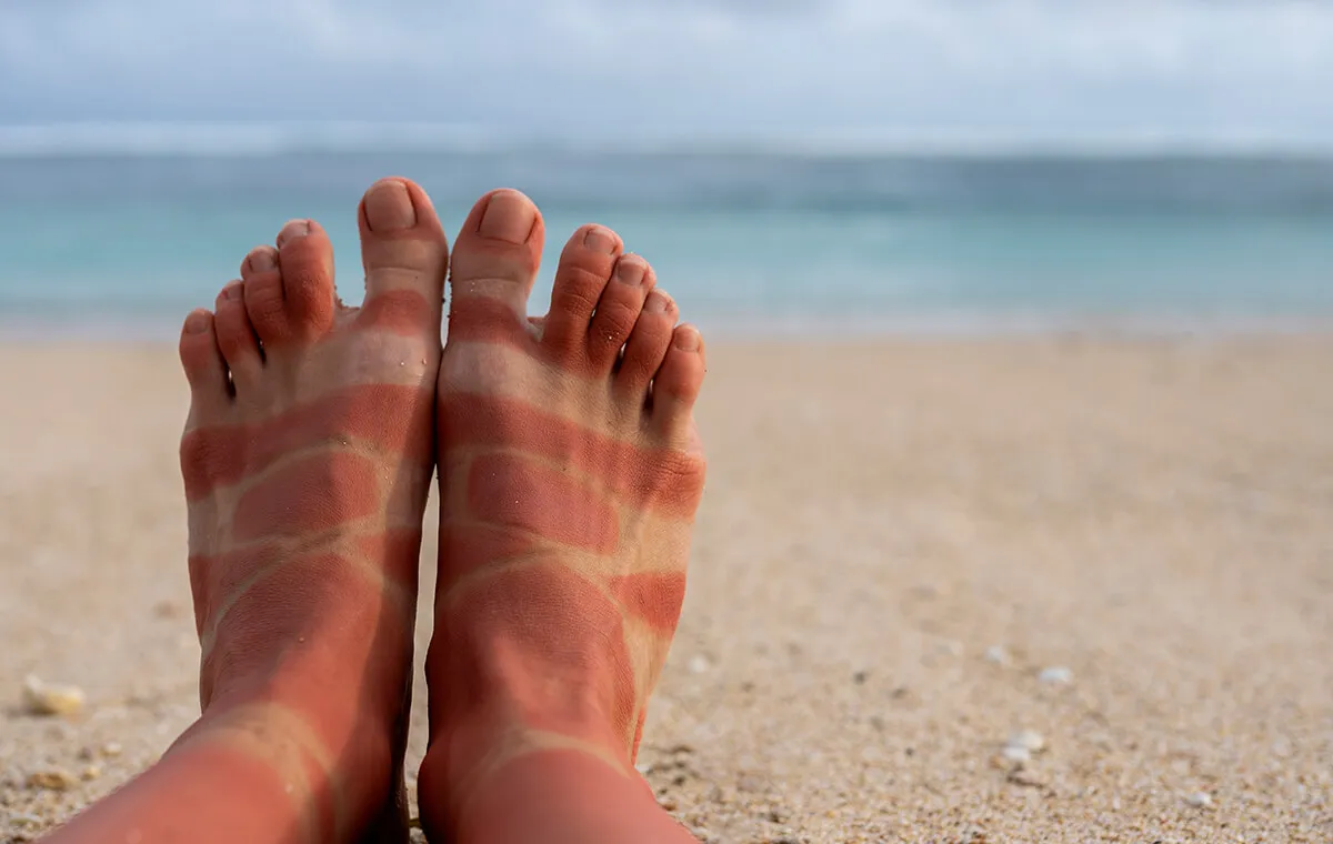 سفید کردن پوست صورت آفتاب سوخته