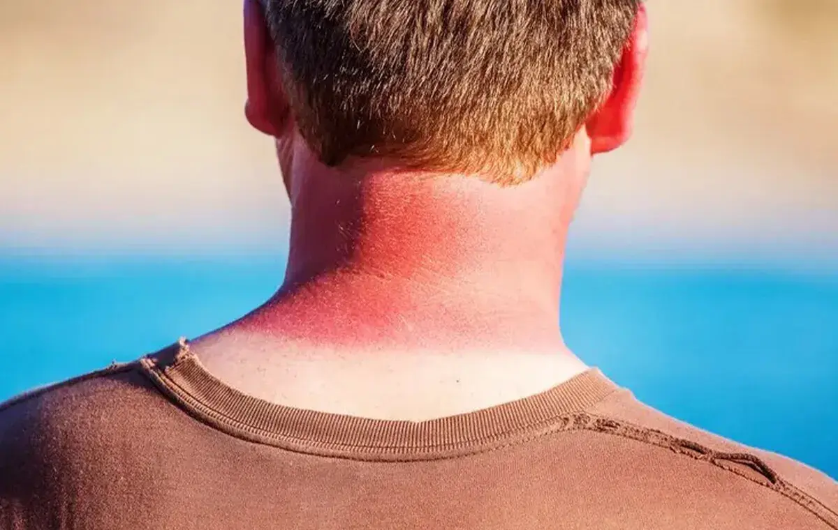سفید کردن پوست آفتاب سوخته کودکان