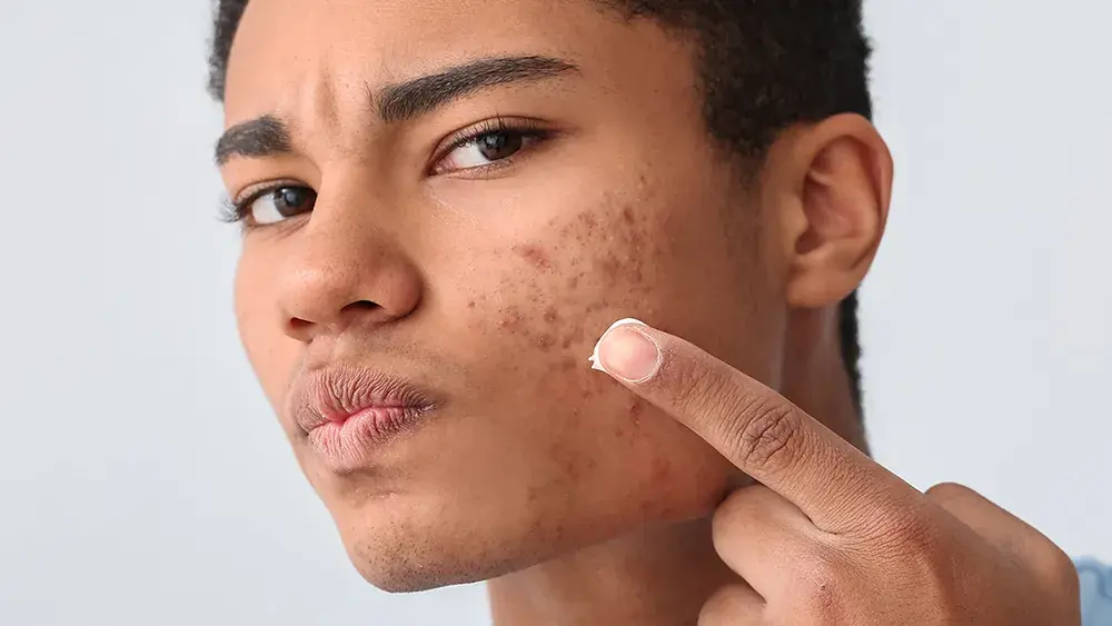 facial scars
